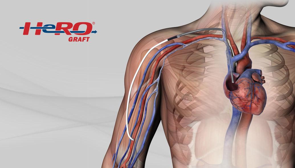 HeRO Graft - Hemodialysis Reliable Outflow