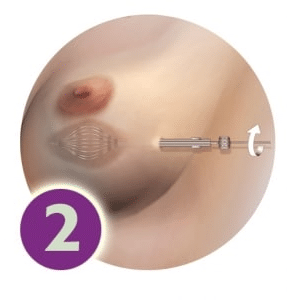 SAVI Brachy - Step 2 - Expansion