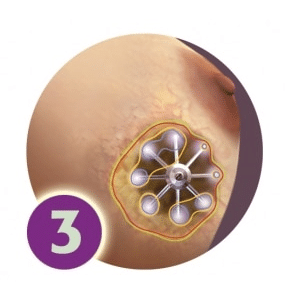 SAVI Brachy - Step 3 - Radiation Delivery