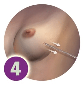 SAVI Brachy - Step 4 - Removal