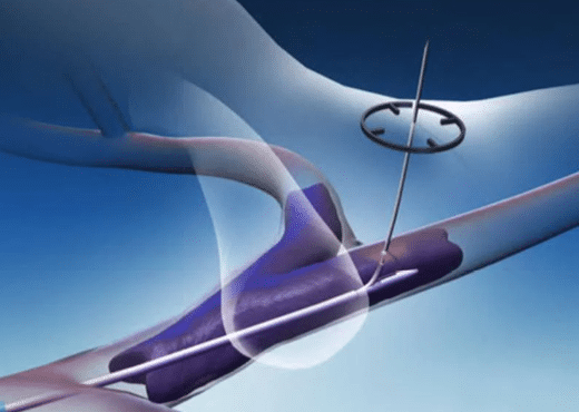 Surfacer Now Available In the United States - Merit Medical