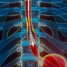 GI Stricture Management
