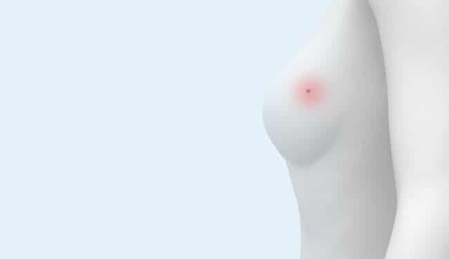 Think Wire-Free Tumor Localization Physician Education