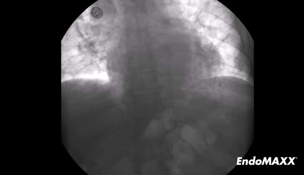 EndoMAXX Removal via the Proximal Suture
