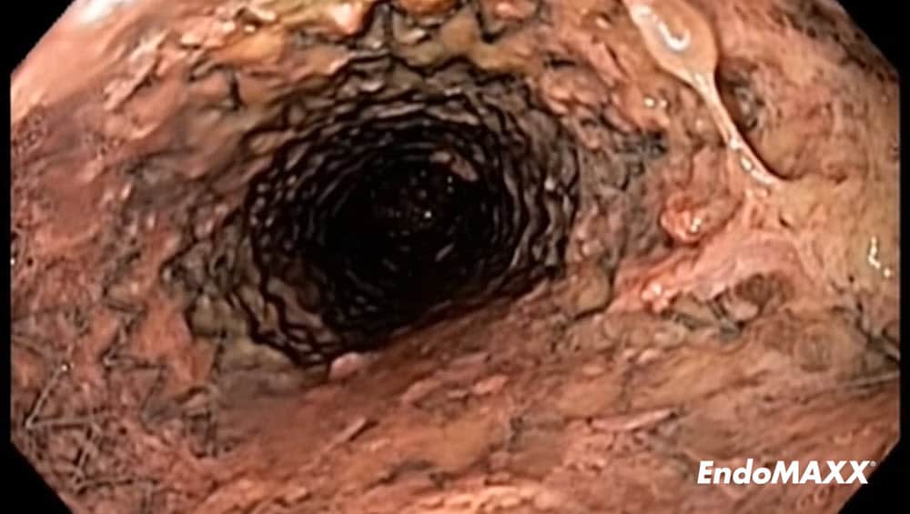 EndoMAXX Removal via the Proximal Suture