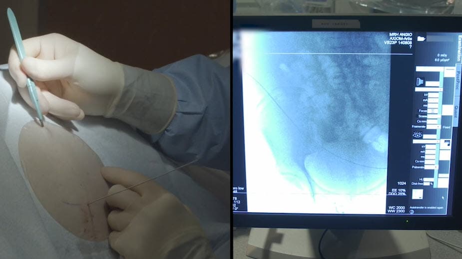 Aspira: Insertion of a Peritoneal Catheter