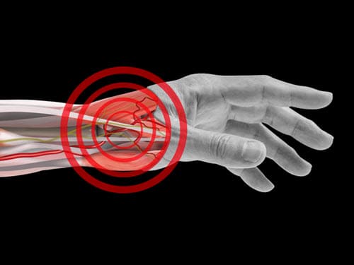 Cut away image of wrist with bullseye on distal radial artery