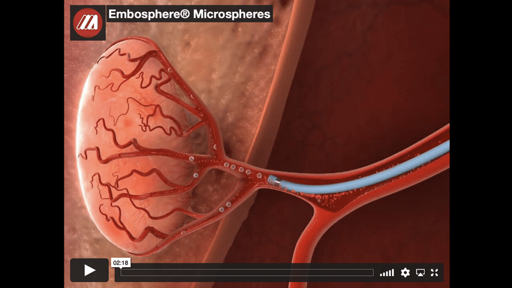 Embosphere Microspheres