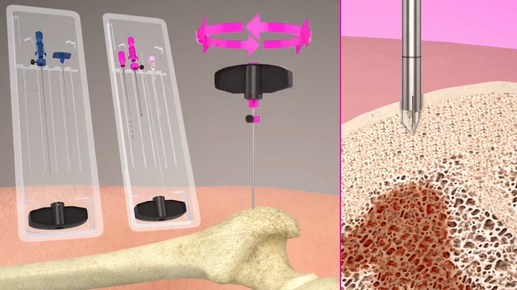HUNTINGTON BONE BIOPSY SYSTEM PROCEDURE