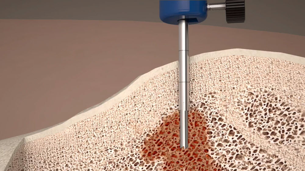 MADISON BONE BIOPSY SYSTEM PROCEDURE