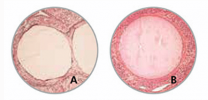 Microsperes six month (A) and six years (B) after embolization of facial AVM