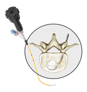 Ossoflex steerable and straight balloon, showing insertion