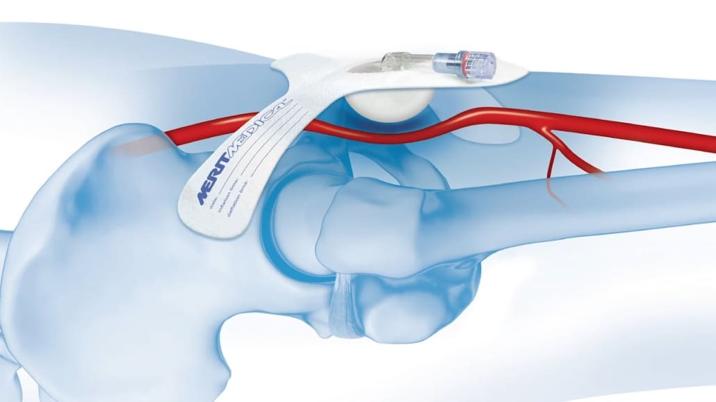 SafeGuard Compression Device [In-Service]