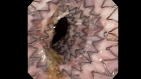 Fully Covered Esophageal Stent Placement for Malignant Dysphagia – EndoMAXX Esophageal Stent
