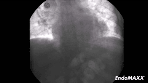 EndoMAXX Deployment Across the Gastroesophageal Junction [In-Service]