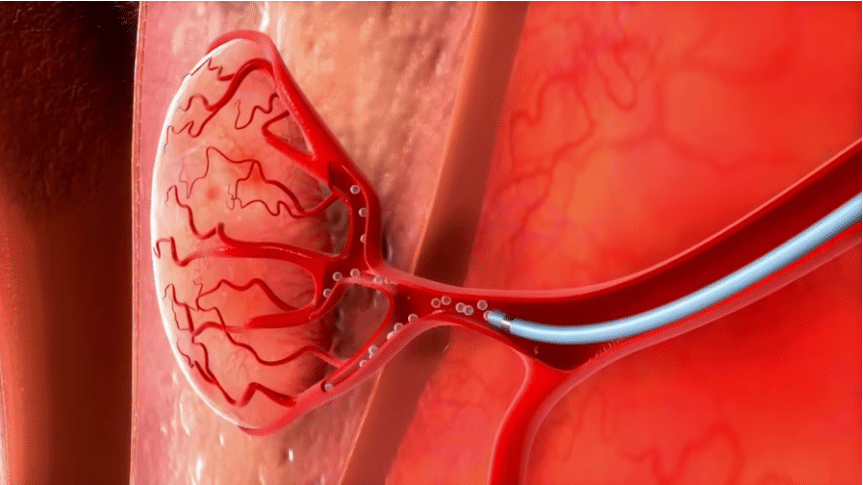 Maestro® Microcatheter [Introduction]