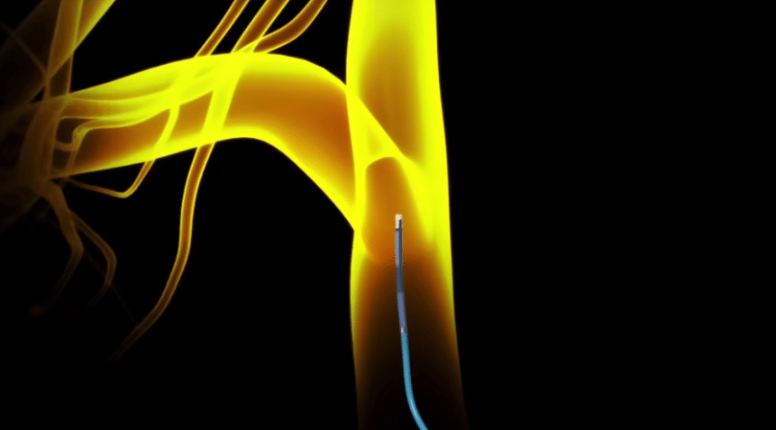 SwiftNINJA Steerable Microcatheter [In-Service]
