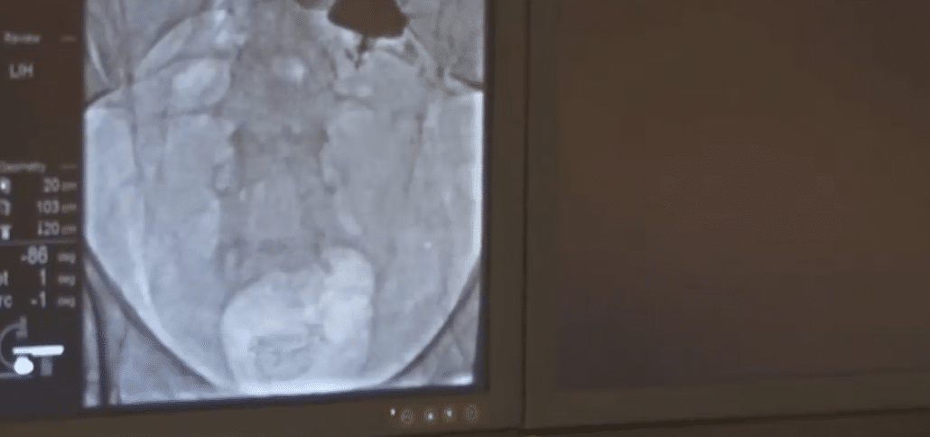 Peritoneal Dialysis: Percutaneous Implantation with Flex-Neck Catheters [In-Service]