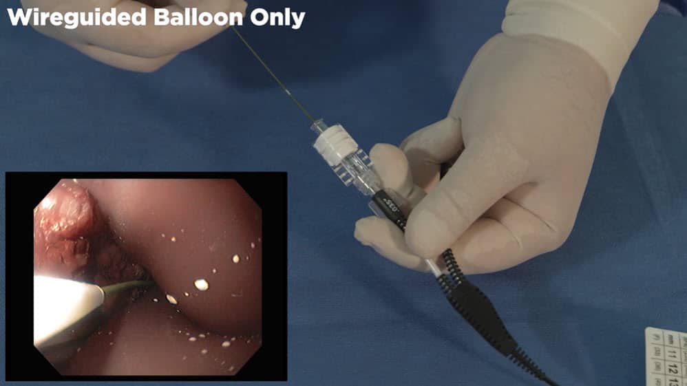 Elation Balloon Dilator [In-Service]