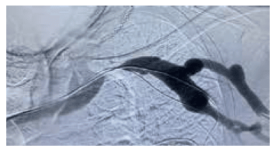 Clinically significant subclavian stenosis - Merit WRAPSODY