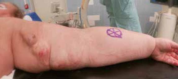 42-year-old female patient with ESRD with an history of multiple reinterventions