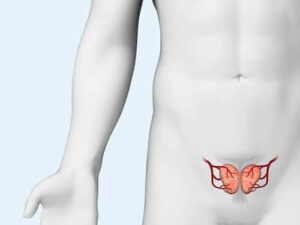 Interventional Techniques for Prostatic Artery Embolization