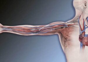 An illustrated look at the HeRO Graft, showing the veins within an arm